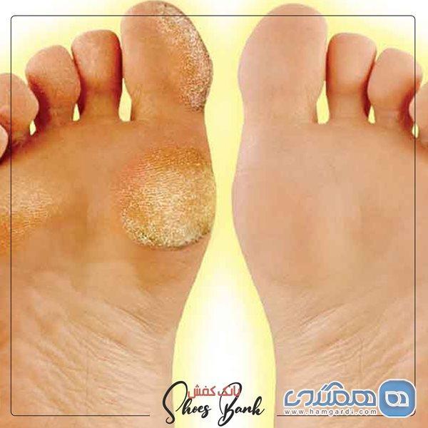 بهترین راهکارها برای رفع پینه پوست بهترین راهکارها برای برطرف پینه پوست