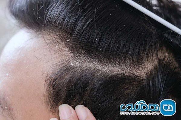 شوره سر را جدی بگیرید شوره سر را جدی بگیرید