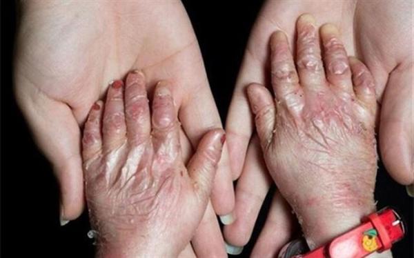بیش از 14 هزار قطعه پانسمان بیماران ای بی در انبار هیات امنای بیش از 14 هزار قطعه پانسمان بیماران ای بی در انبار هیات امنای صرفه جویی ارزی موجود است